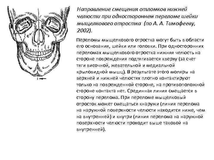 Направление смещения отломков нижней челюсти при одностороннем переломе шейки мыщелкового отростка (по А. А.