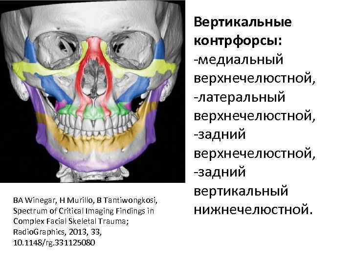 Перелом лицевого черепа. Контрфорсы черепа верхней челюсти. Контрфорсы верхней челюсти анатомия. Контрфорсы черепа анатомия. Контрфорсы нижней челюсти.