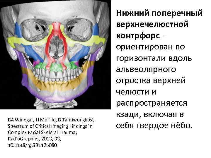 Перелом верхней стенки верхнечелюстной пазухи