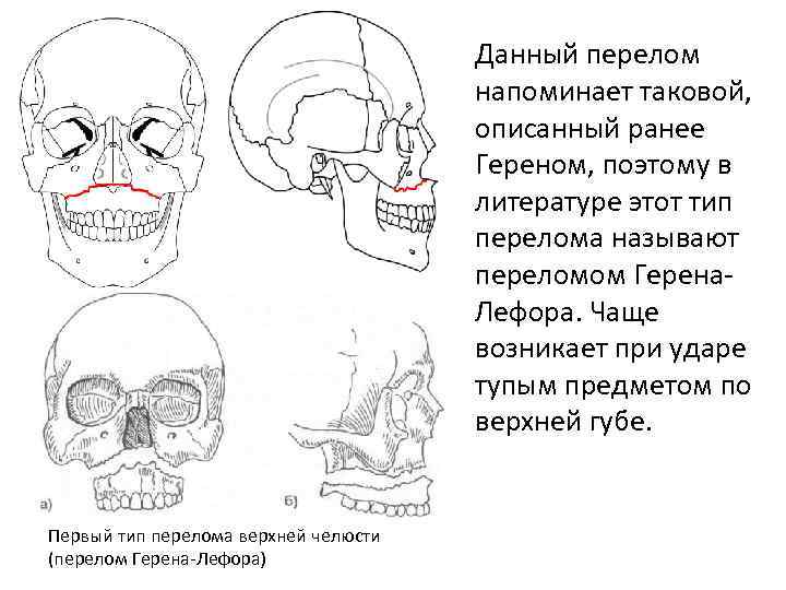 Перелом лицевого черепа. Перелом верхней челюсти Герена. Перелом костей лицевого черепа. Переломы лицевого черепа по Лефору.