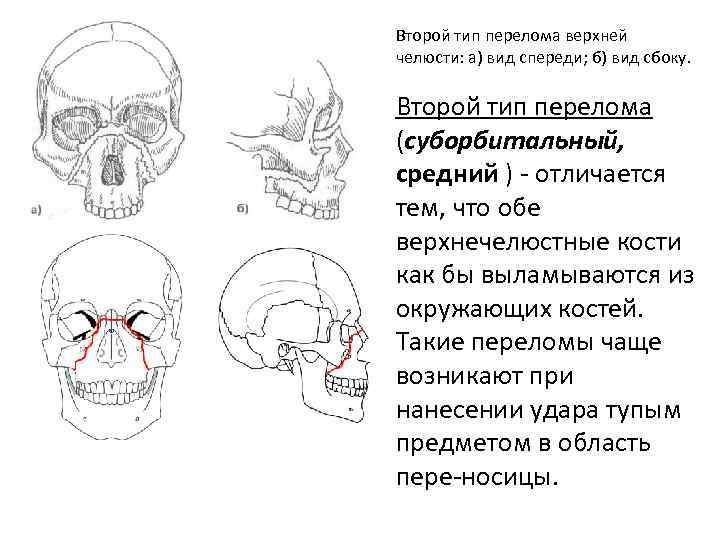 Верхняя скуловая кость. Лефор классификация переломов верхней челюсти. Перелом верхней скуловой кости. Классификация переломов челюстей лицевого скелета..