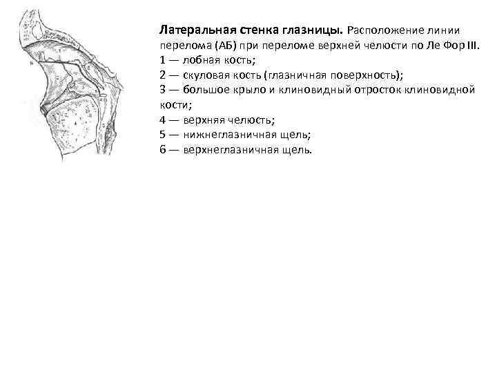 Латеральная стенка глазницы. Расположение линии перелома (АБ) при переломе верхней челюсти по Ле Фор