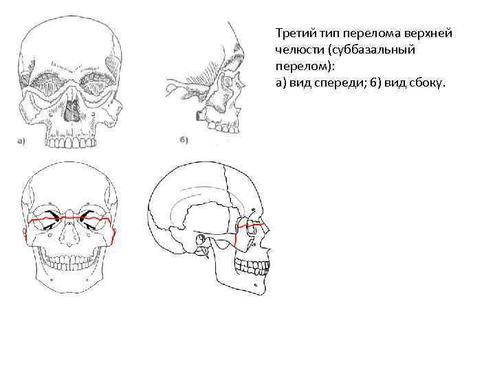 Третий тип перелома верхней челюсти (суббазальный перелом): а) вид спереди; 6) вид сбоку. 