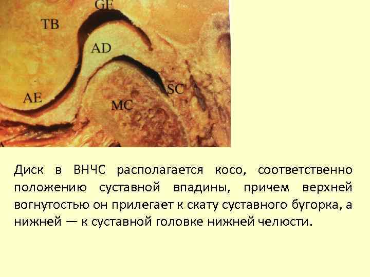 Диск в ВНЧС располагается косо, соответственно положению суставной впадины, причем верхней вогнутостью он прилегает