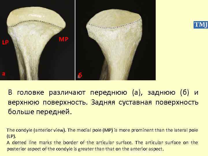 LP а MP б В головке различают переднюю (a), заднюю (б) и верхнюю поверхность.