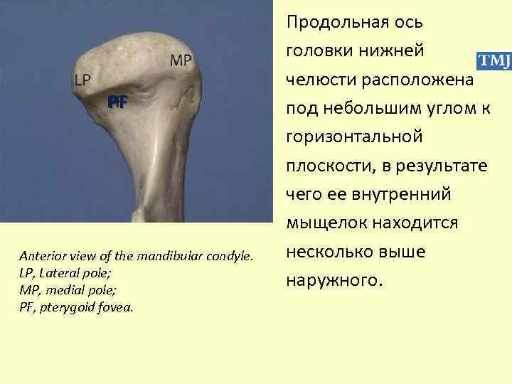 PF Anterior view of the mandibular condyle. LP, Lateral pole; MP, medial pole; PF,