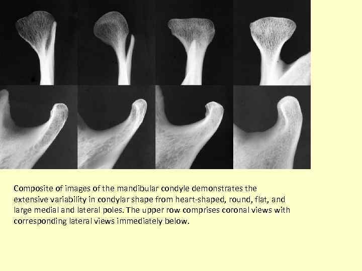 Composite of images of the mandibular condyle demonstrates the extensive variability in condylar shape