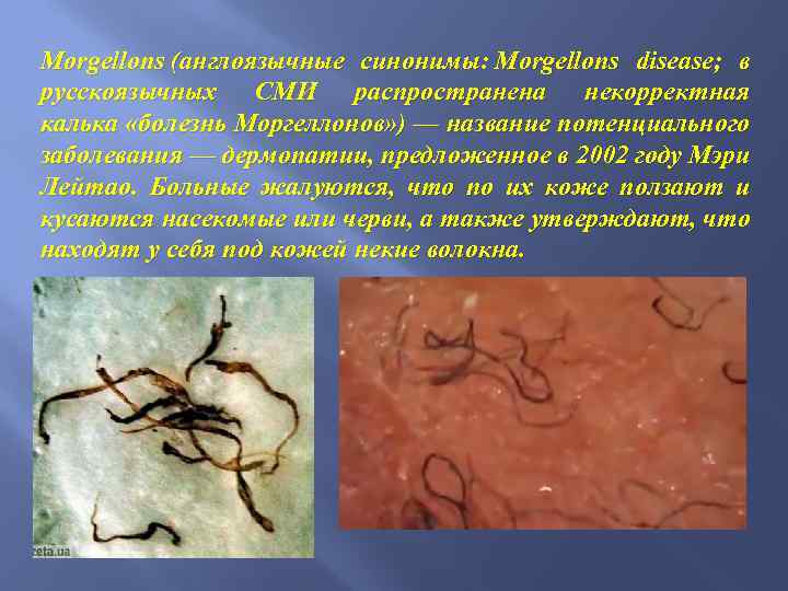 Morgellons (англоязычные синонимы: Morgellons disease; в русскоязычных СМИ распространена некорректная калька «болезнь Моргеллонов» )