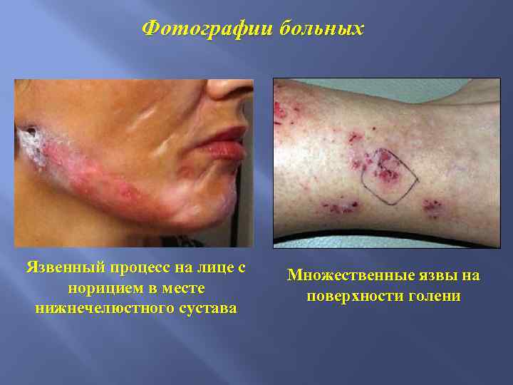 Фотографии больных Язвенный процесс на лице с норицием в месте нижнечелюстного сустава Множественные язвы