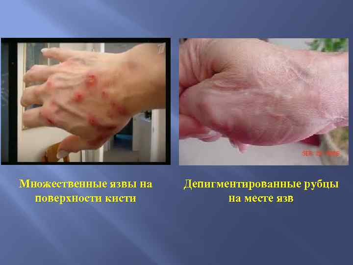Множественные язвы на поверхности кисти Депигментированные рубцы на месте язв 