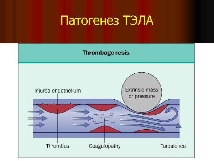 Патогенез ТЭЛА 