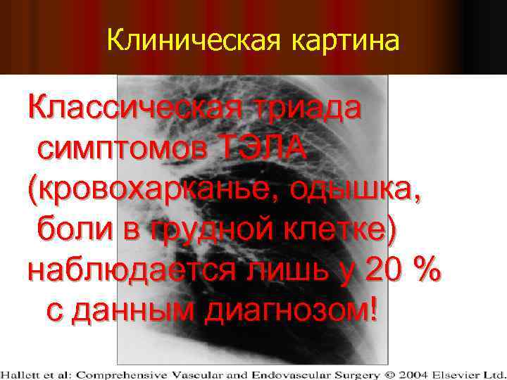 Клиническая картина Классическая триада симптомов ТЭЛА (кровохарканье, одышка, боли в грудной клетке) наблюдается лишь