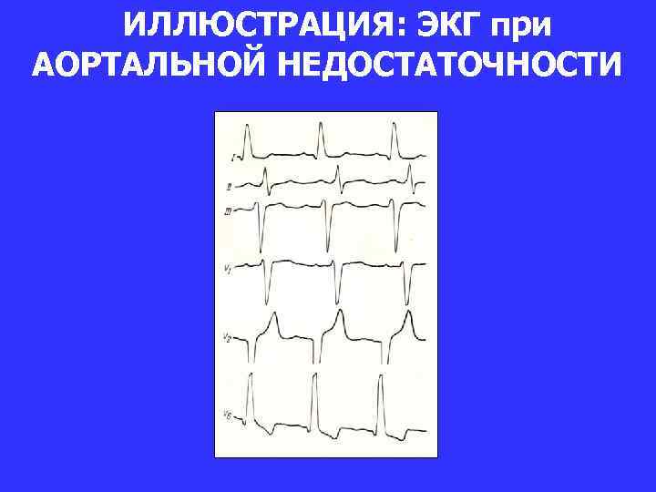 ИЛЛЮСТРАЦИЯ: ЭКГ при АОРТАЛЬНОЙ НЕДОСТАТОЧНОСТИ 