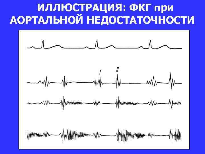 ИЛЛЮСТРАЦИЯ: ФКГ при АОРТАЛЬНОЙ НЕДОСТАТОЧНОСТИ 