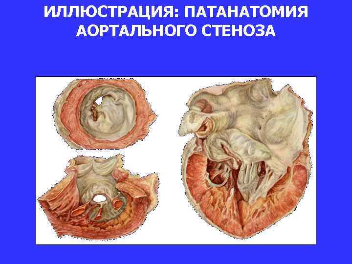 ИЛЛЮСТРАЦИЯ: ПАТАНАТОМИЯ АОРТАЛЬНОГО СТЕНОЗА 