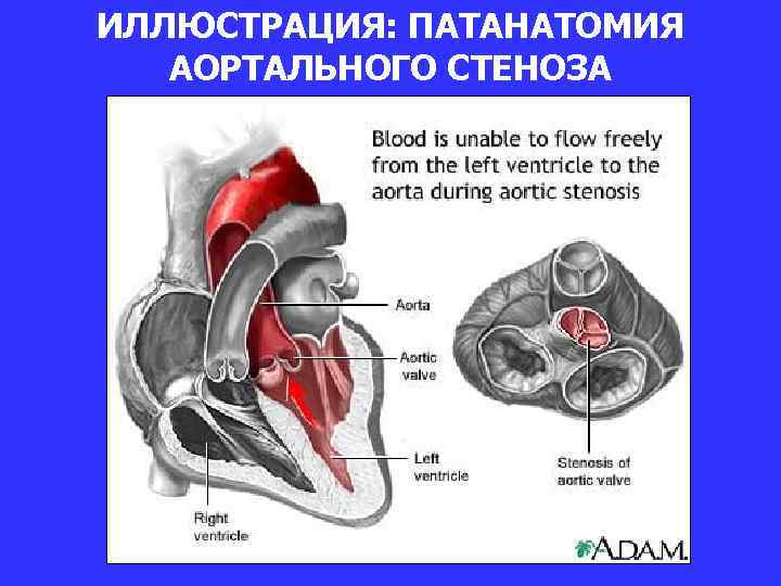 Площадь открытия аортального клапана