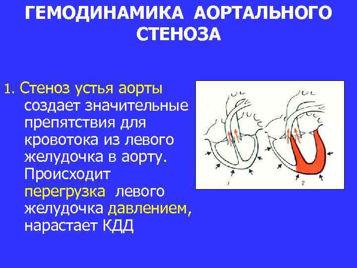 Аортальная недостаточность презентация