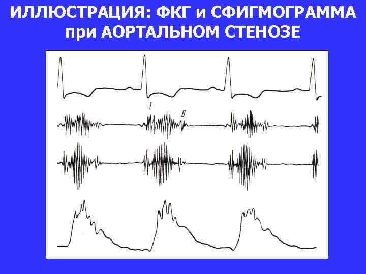 ИЛЛЮСТРАЦИЯ: ФКГ и СФИГМОГРАММА при АОРТАЛЬНОМ СТЕНОЗЕ 