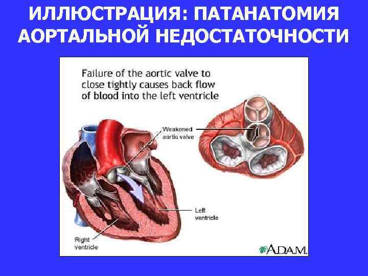 Недостаточность аортального клапана патогенез