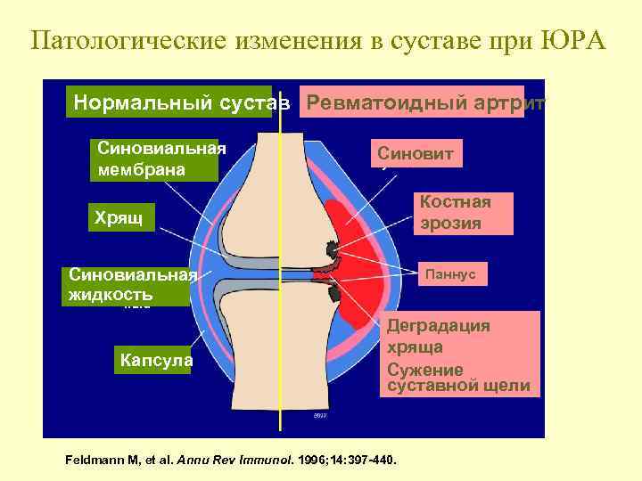 Патологические изменения в суставе при ЮРА Нормальный сустав Ревматоидный артрит Синовиальная мембрана Синовит Костная