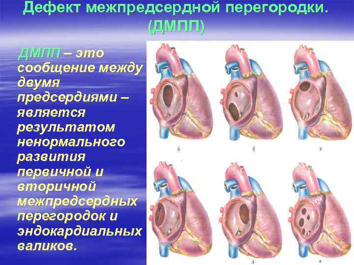 Дефект межпредсердной перегородки. (ДМПП) ДМПП – это сообщение между двумя предсердиями – является результатом