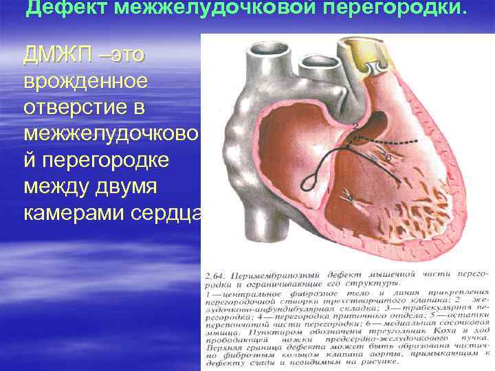 Дефект межжелудочковой перегородки. ДМЖП –это врожденное отверстие в межжелудочково й перегородке между двумя камерами