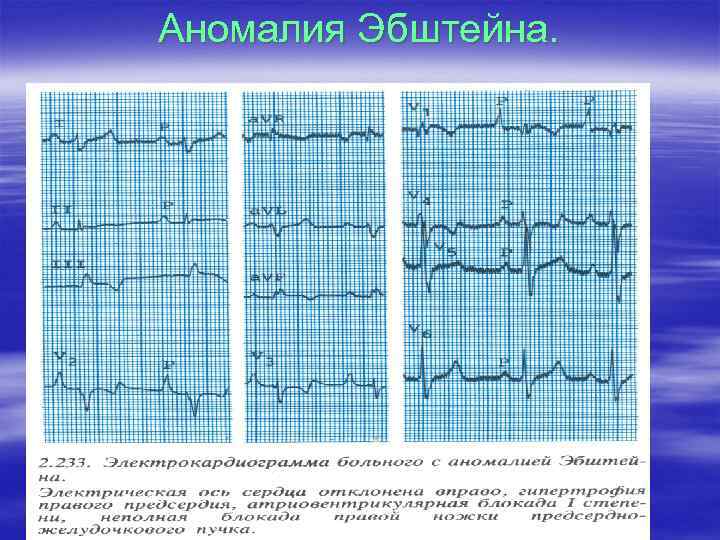 Аномалия Эбштейна. 