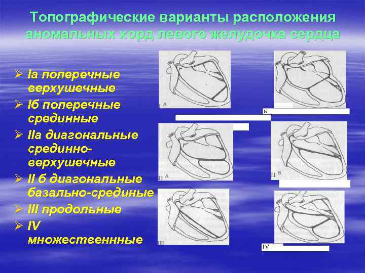 Топографические варианты расположения аномальных хорд левого желудочка сердца Ø Iа поперечные верхушечные Ø Iб