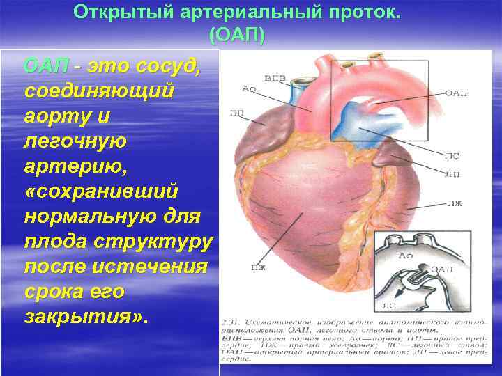 Открытый артериальный проток. (ОАП) ОАП - это сосуд, соединяющий аорту и легочную артерию, «сохранивший