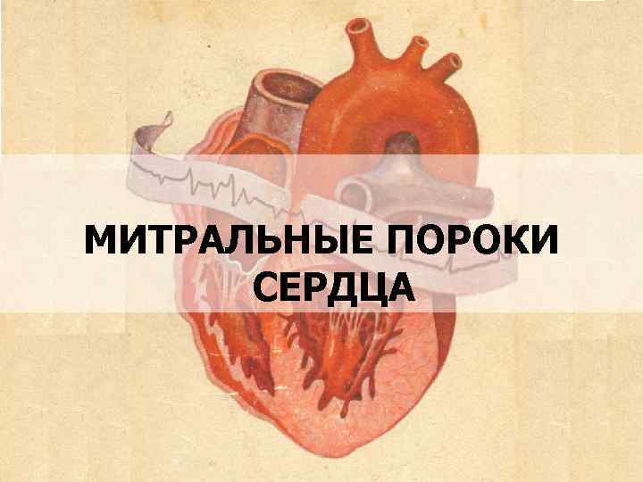 МИТРАЛЬНЫЕ ПОРОКИ СЕРДЦА 