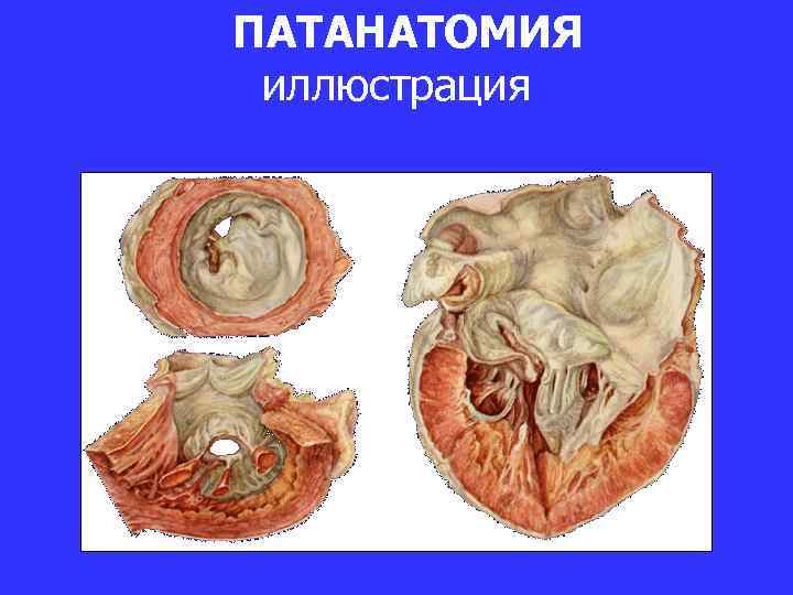 ПАТАНАТОМИЯ иллюстрация 