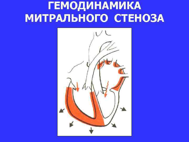 ГЕМОДИНАМИКА МИТРАЛЬНОГО СТЕНОЗА 
