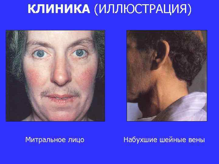 КЛИНИКА (ИЛЛЮСТРАЦИЯ) Митральное лицо Набухшие шейные вены 