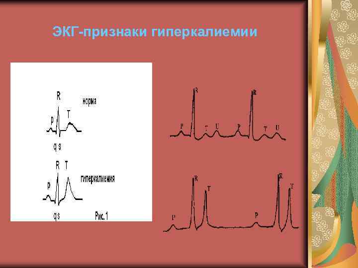 Гиперкалиемия на экг картинки