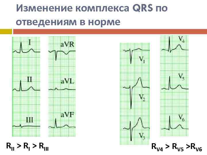 Изменение комплекса QRS по отведениям в норме RII > RIII RV 4 > RV