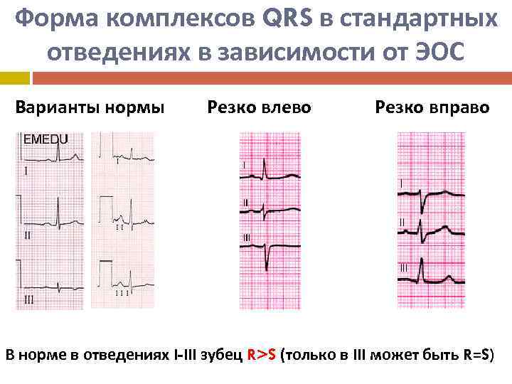 Форма комплексов QRS в стандартных отведениях в зависимости от ЭОС Варианты нормы Резко влево