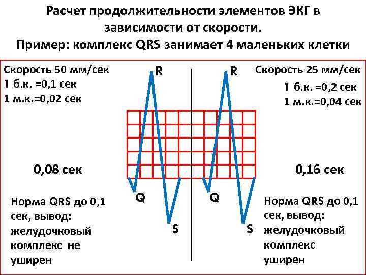 Большой подсчет. Как посчитать комплекс QRS на ЭКГ. Подсчет QRS на ЭКГ. Как рассчитать ЭКГ 50мм QRS. Расчёт ЭКГ при 50 мм.