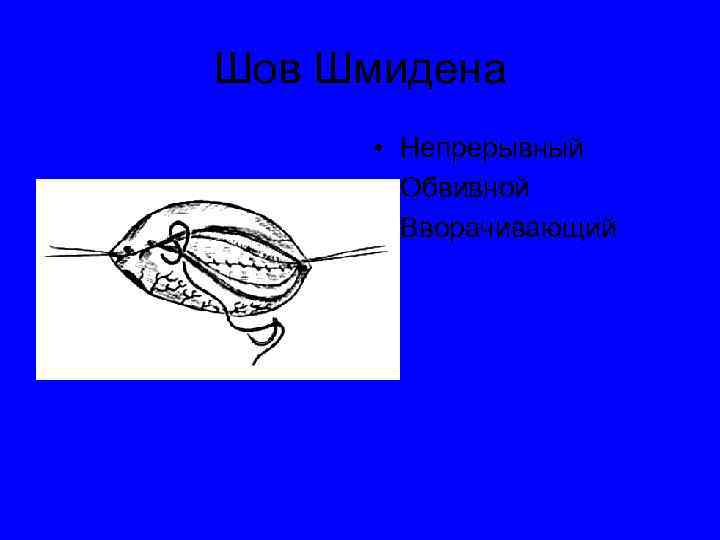 Вворачивающий сквозной шов через все слои кишечной стенки называют