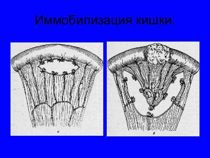 Иммобилизация кишки. 