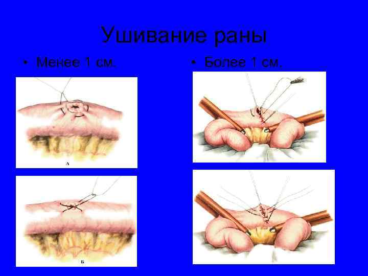 Ушивание раны • Менее 1 см. • Более 1 см. 