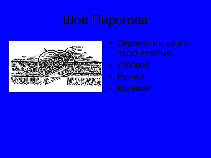 Вворачивающий сквозной шов через все слои кишечной стенки называют