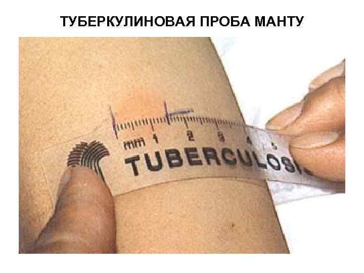 ТУБЕРКУЛИНОВАЯ ПРОБА МАНТУ 