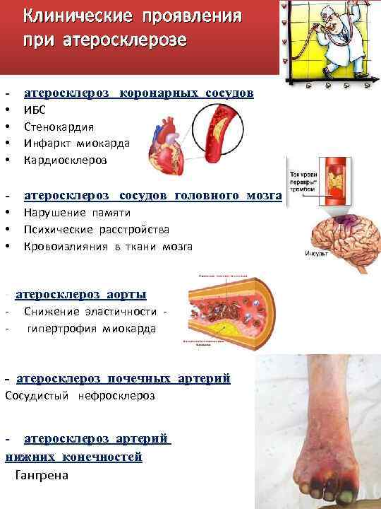Клинические проявления при атеросклерозе - атеросклероз коронарных сосудов • • ИБС Стенокардия Инфаркт миокарда