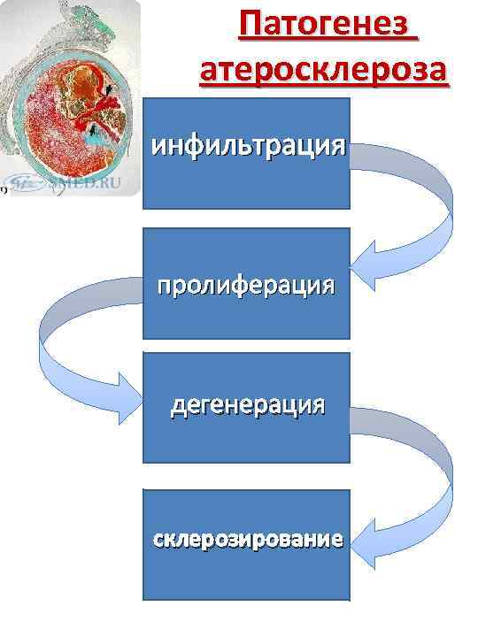 Патогенез атеросклероза инфильтрация пролиферация дегенерация склерозирование 