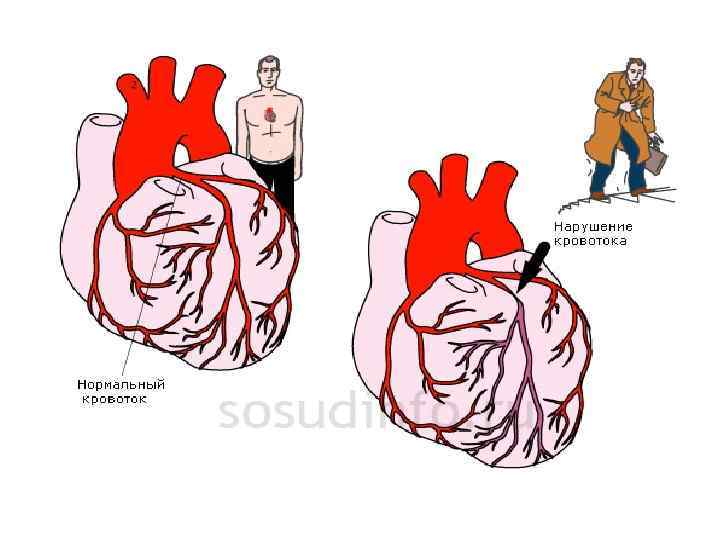 Хроническая ишемическая болезнь сердца картинки