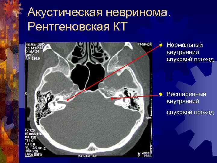 Акустическая невринома. Рентгеновская КТ ® Нормальный внутренний слуховой проход ® Расширенный внутренний слуховой проход