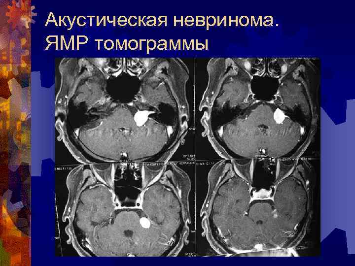 Акустическая невринома. ЯМР томограммы 