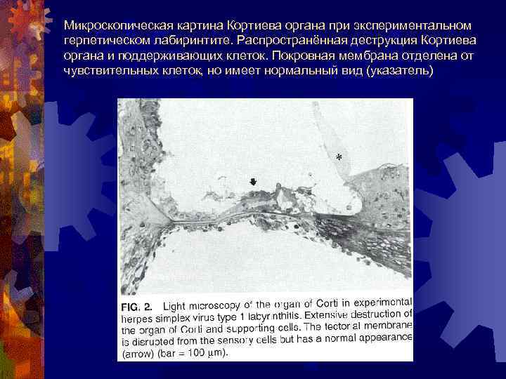 Микроскопическая картина Кортиева органа при экспериментальном герпетическом лабиринтите. Распространённая деструкция Кортиева органа и поддерживающих