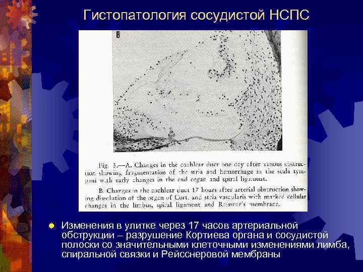 Гистопатология сосудистой НСПС ® Изменения в улитке через 17 часов артериальной обструкции – разрушение