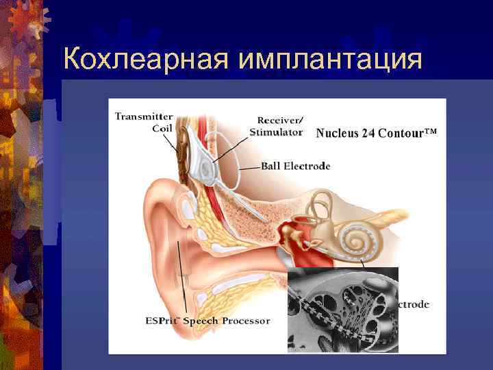 Кохлеарная имплантация 